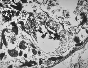 M, | cerebral cortex - malaric pigment M, | cerebral cortex - malaric pigment
